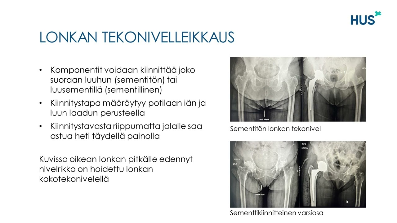 Lonkan ja polven tekonivelleikkaukset Peijaksen sairaalassa