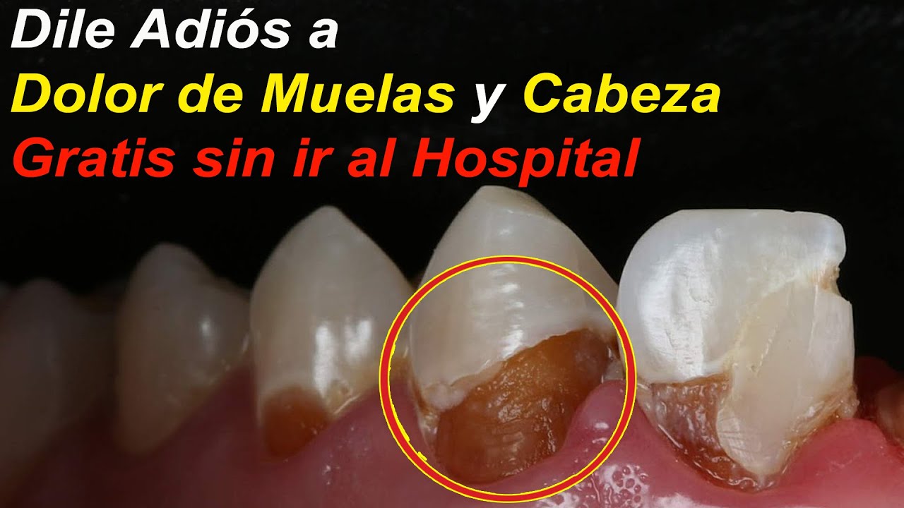Esto es lo Mejor para Quitar Dolor de Muelas sin ir al Dentista - YouTube