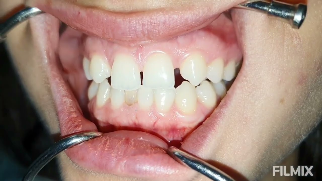 Lateral diş eksikliği tedavisi tek seansta fiber bondingle