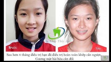 Ca thực tế, điều trị khớp cắn ngược, khấp khểnh nặng tại Nha Khoa Thùy Anh