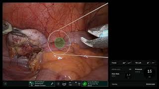 DV5 Appendectomy with force feedback and 8mm stapler