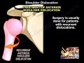 Shoulder Dislocations - Everything You Need To Know - Dr. Nabil Ebraheim