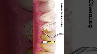 Teeth Cleaning Procedure Explained (3D Animation)#3danimation #medicaleducation #healthcare #fyp