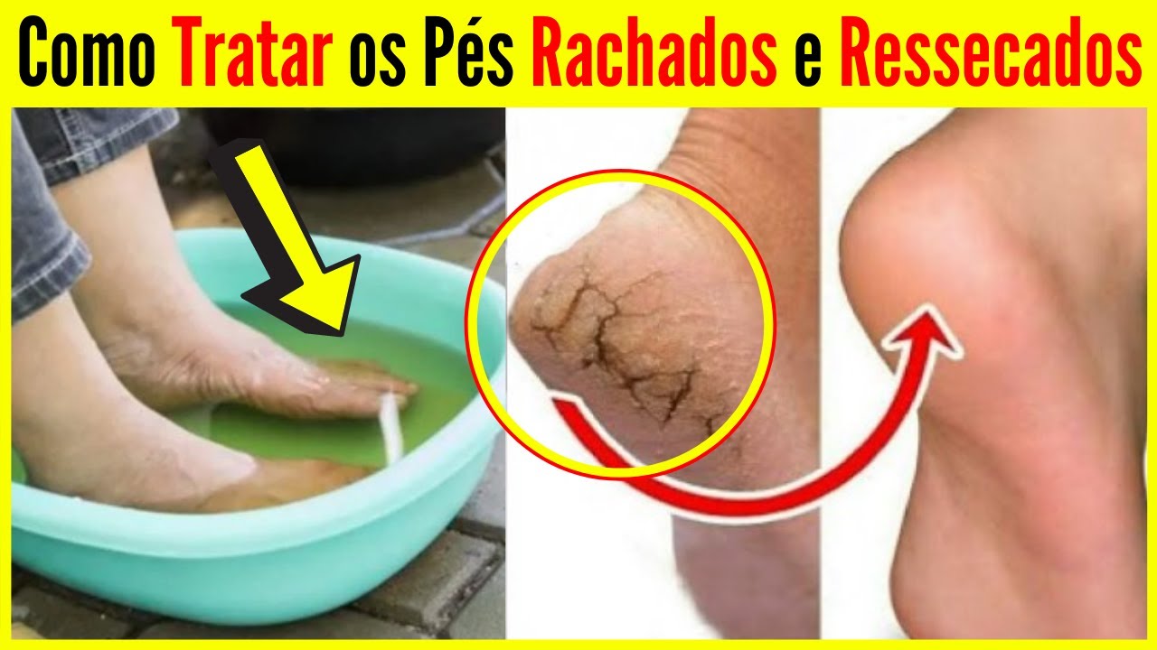 Como Tratar os Pés Rachados e Ressecados - YouTube