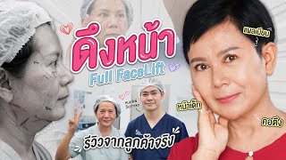 ดึงหน้าย้อนวัย Full Facelift  หน้าเด็ก คอตึง แผลเนียน ที่ Someko