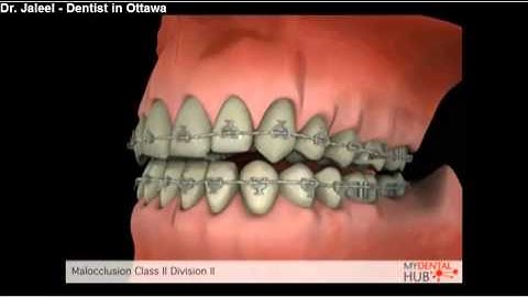 Orthodontics - Malocclusion Class II Division II - Ottawa Dentist