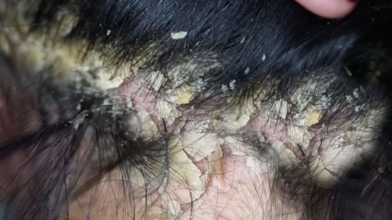 relaxing Treatment and Dandruff Removal Scratching#26