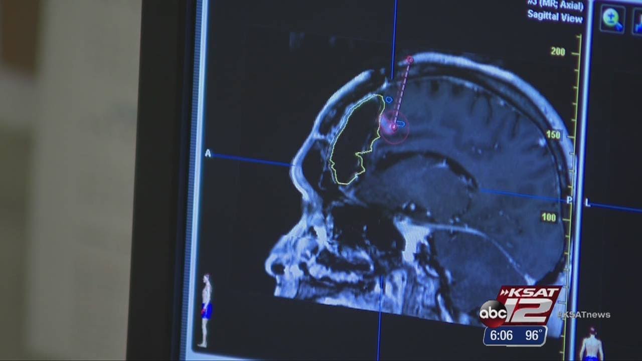 Brain tumors stopped with new CTRC radiation process