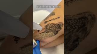 Remove Tattoos With Picosecond Oaser
