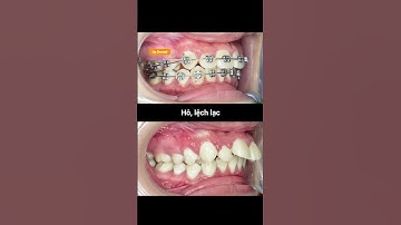 Cận cảnh quá trình thay đổi khi niềng răng hô và lệch lạc