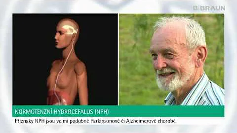 Jak se léčí obstrukční hydrocefal?