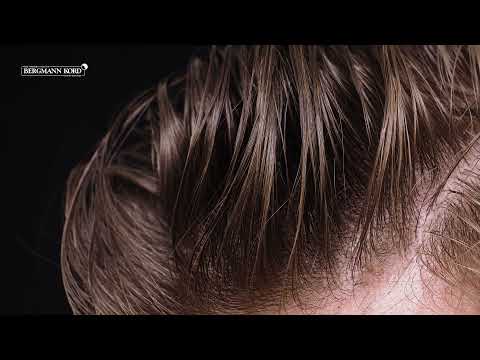 FAQs : Hair Transplant Recovery