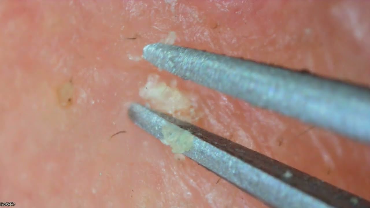 0020 keratin plug removal nose 鼻角栓抜き 鼻 YouTube