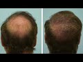 Dallas Male Hair Transplant Close-Up
