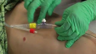 Adhesive Foley Securement Device