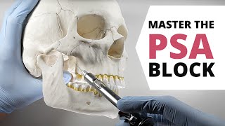 HOW TO DO A POSTERIOR SUPERIOR ALVEOLAR (PSA) NERVE BLOCK | OnlineExodontia.com