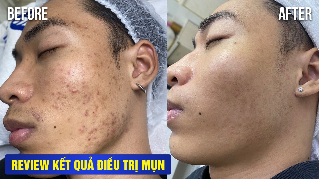 TỪNG "TỰ TI" VÌ MẶT CHI CHÍT THÂM MỤN ĐẾN DA SẠCH MỤN, HẾT THÂM SAU 2 BUỔI.