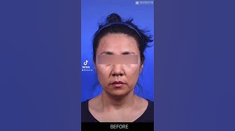 라봄성형외과 - YouTube 라봄성형외과 - Youtube