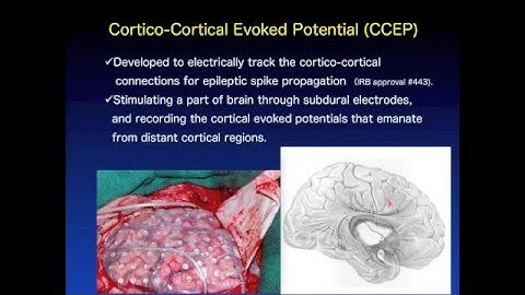 Dr Riki Matsumoto - Imaging cortico-cortical connectivity with cortical stimulation
