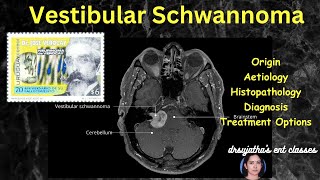 242.Vestibular Schwannoma   /  Acoustic neuroma  #surgeryeducation