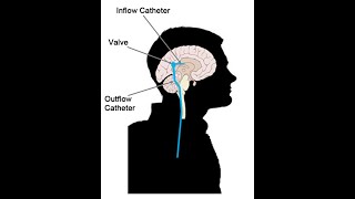 Cerebro-Spinal fluid (CSF) Shunt | Hydrocephalus | Ventriculo-Peritoneal | Intracranial Hypertension