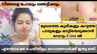 Remove Open pores and Black Marks within 5 use / 100% Natural Tip / My Own Experience / Allu and Me