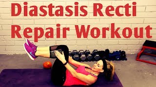 Top Rated 26 How To Fix Diastasis Recti After C Section 2022: Must Read