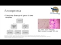 The Workup and Management of Non-Obstructive Azoospermia