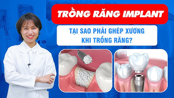 Trồng Răng Implant - Tại Sao Phải Ghép Xương Khi Trồng Răng? | Nam Bùi Vinalign