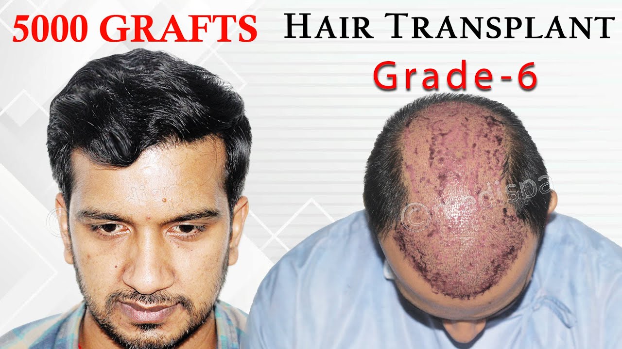 Best Hair Transplant in India in Grade 6 at Best Cost Medispa India