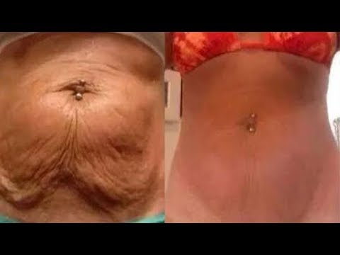 Straffung der Bauchhaut nach dem Abnehmen