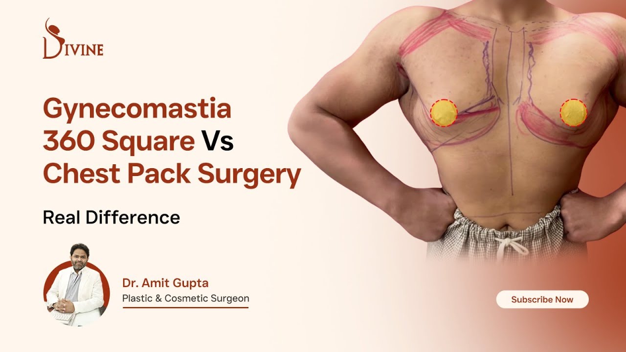 Gynecomastia 360 Square vs Chest Pack Surgery | Why Results Look More Sculpted | Dr Amit Gupta