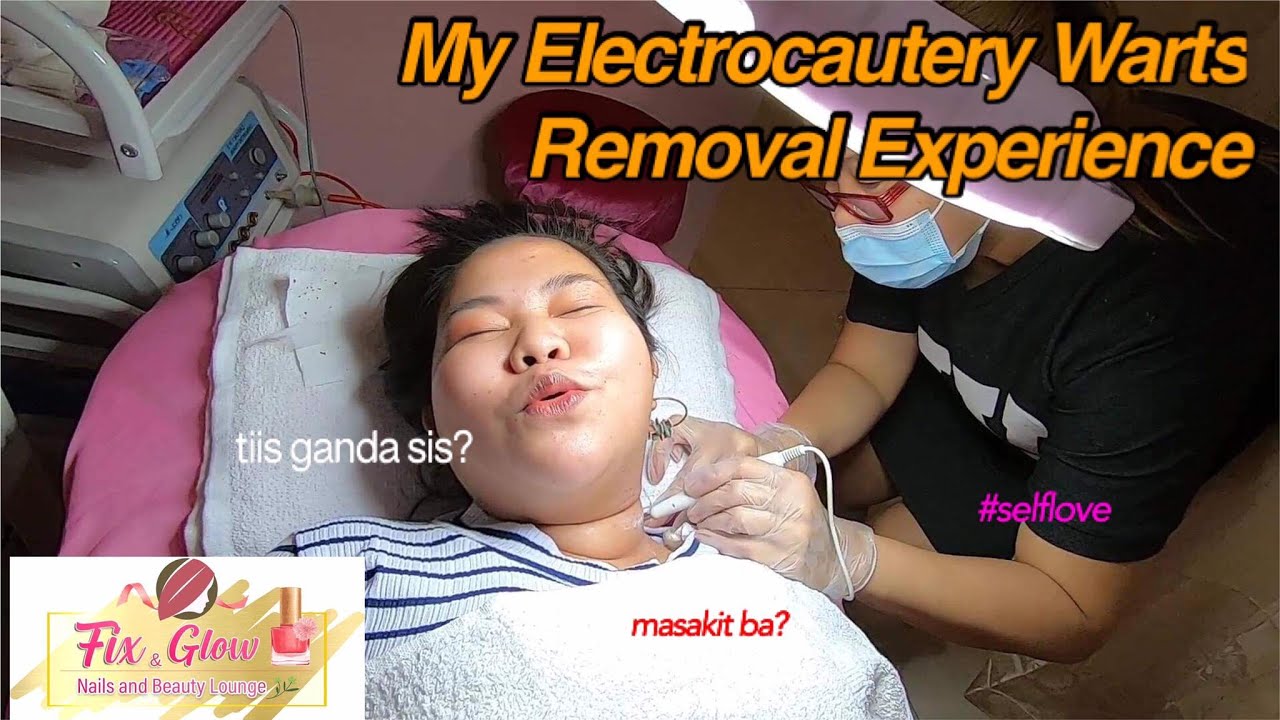 My Electrocautery Warts Removal Experience Fix&Glow Nails and Beauty