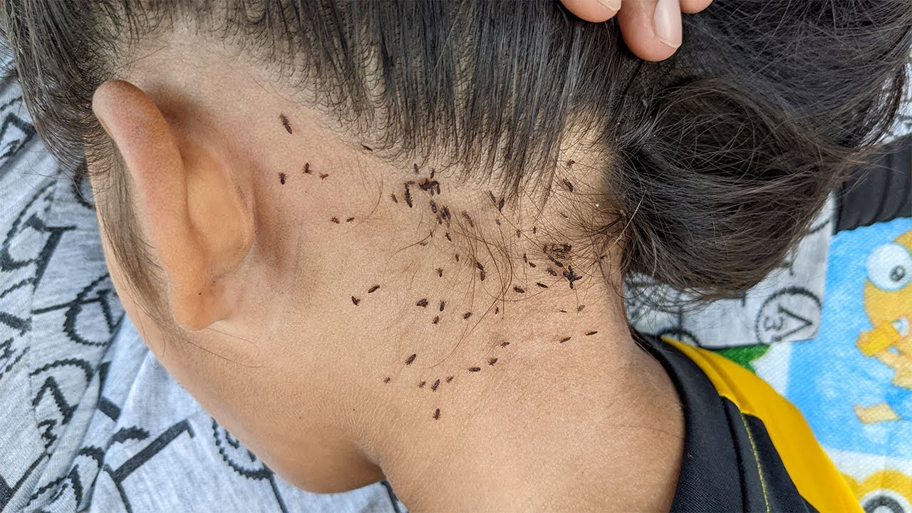 Getting A Lot Of Head Lice From Black Hair How To Remove All Head 