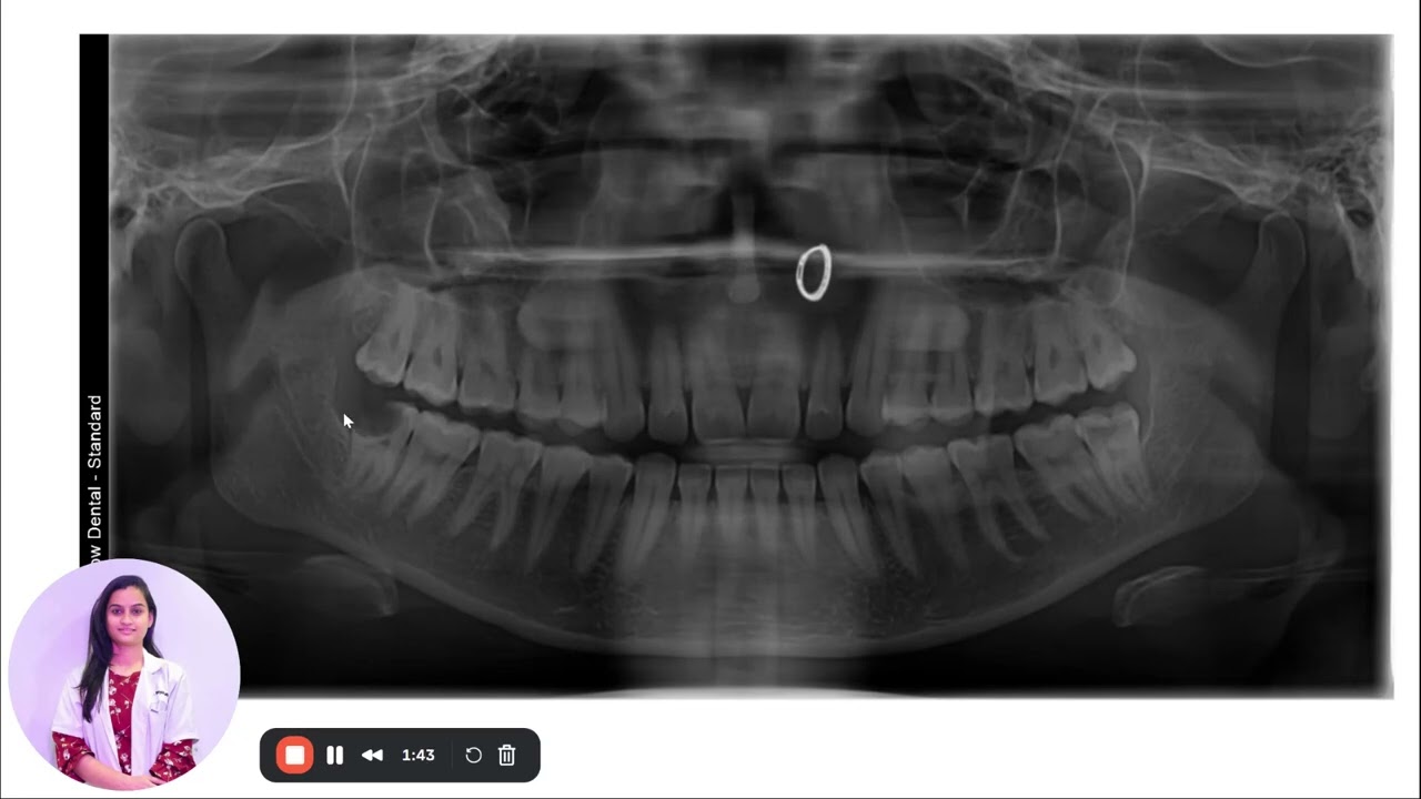 Wisdom Tooth Removal Explained | Dental Case Study & Procedure by Dr. Priyal