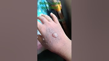 Thumbnail of Boiling water burn hand #share #burnhand #share #hand