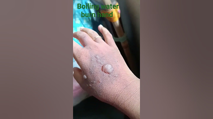 Boiling water burn hand #share #burnhand #share #hand