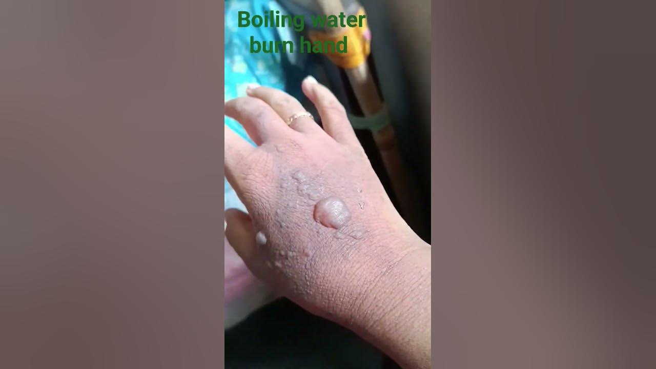 Boiling water burn hand #share #burnhand #share #hand