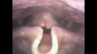 Laryngoscopy: Healthy male opera singer singing