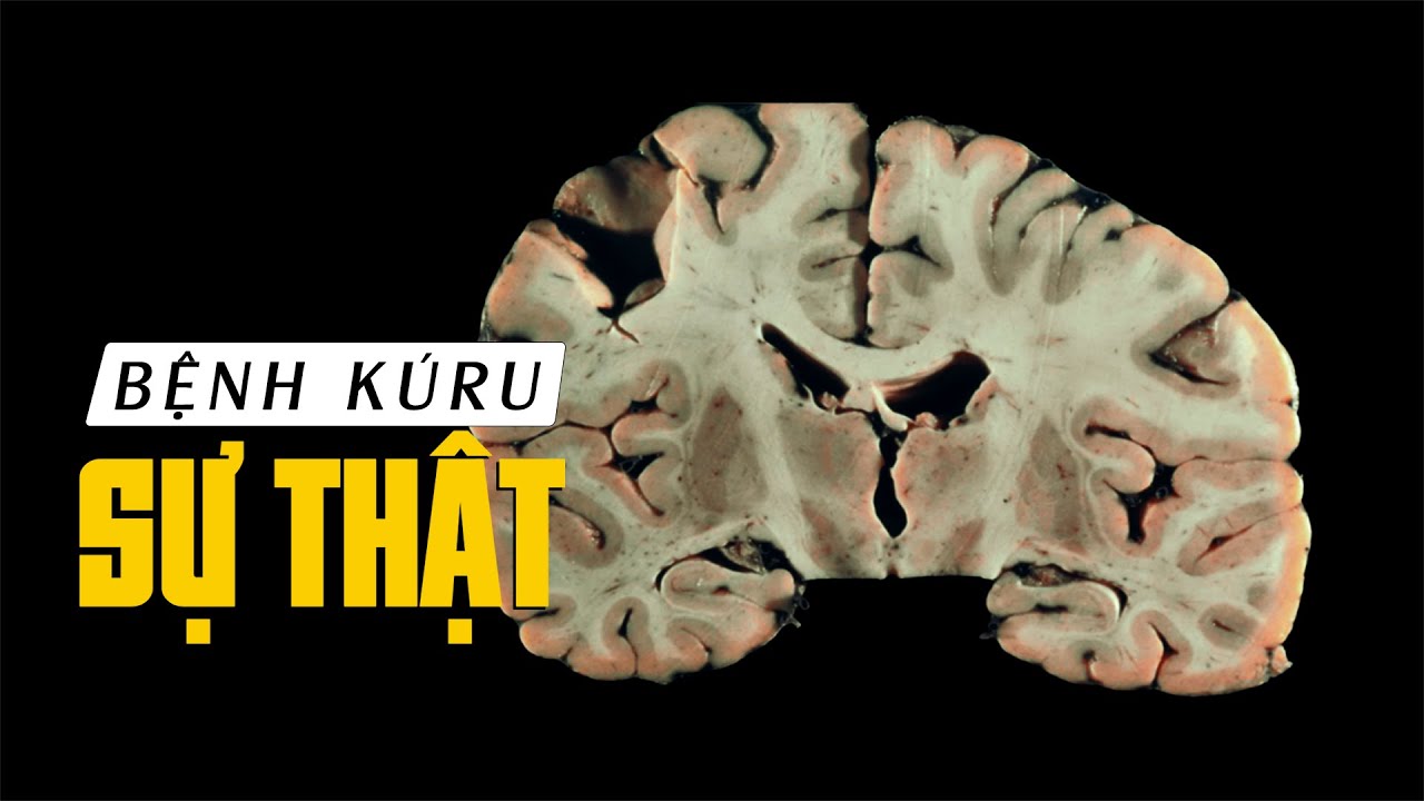 #1045 Sự Thật Về Kuru - Căn Bệnh Bị Nguyền Rủa!