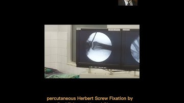 Percutaneous Herbert Screw Fixation of Fracture scaphoid by Prof Tahseen Ahmad Cheema