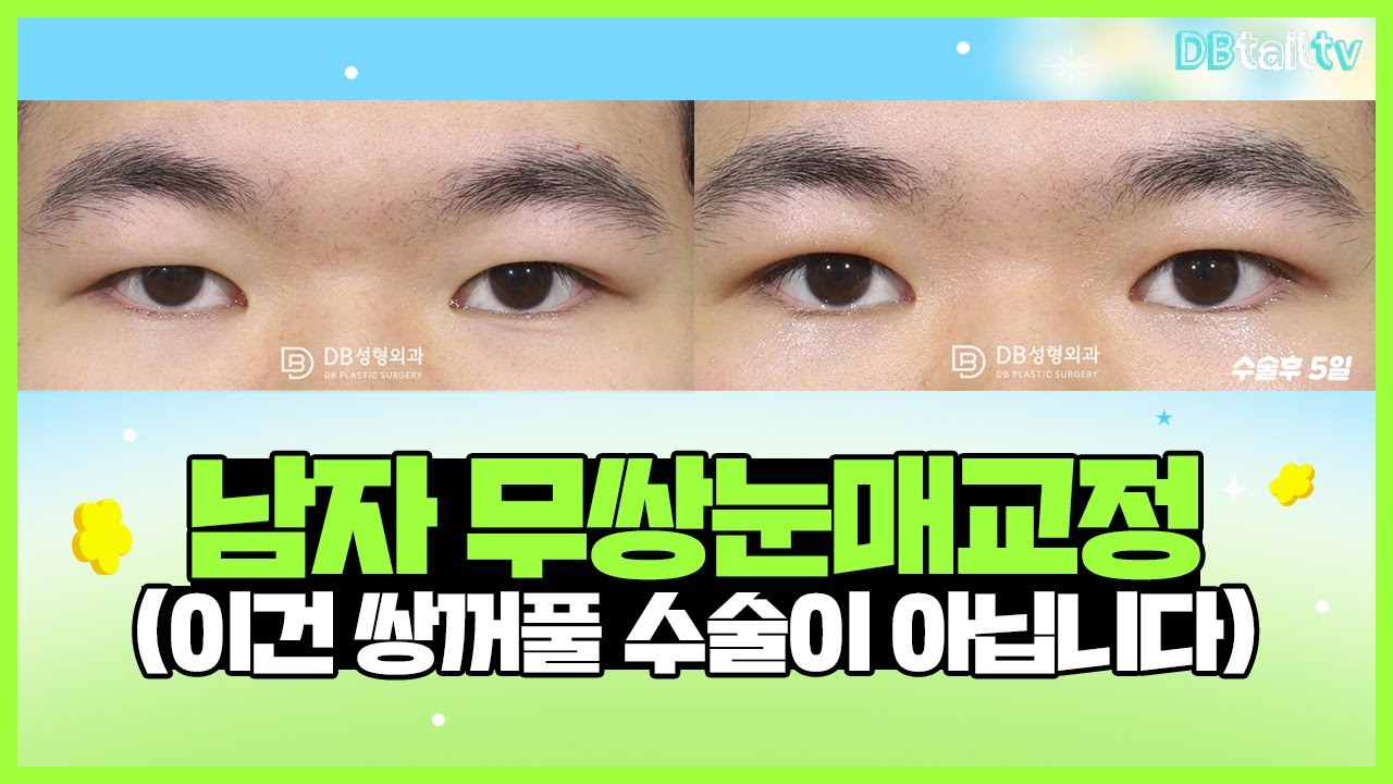 남자 무쌍눈매교정(이건 쌍꺼풀 수술이 아닙니다) - YouTube