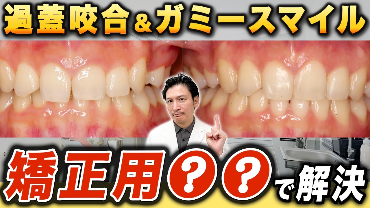 Case study of lingual orthodontics! ~Deep bite edition~] If you