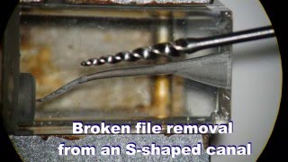 Broken file removal from an S-shaped canal
