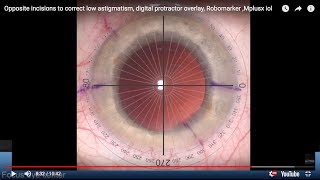 Opposite incisions to correct low astigmatism, digital protractor overlay, Robomarker ,Mplusx iol