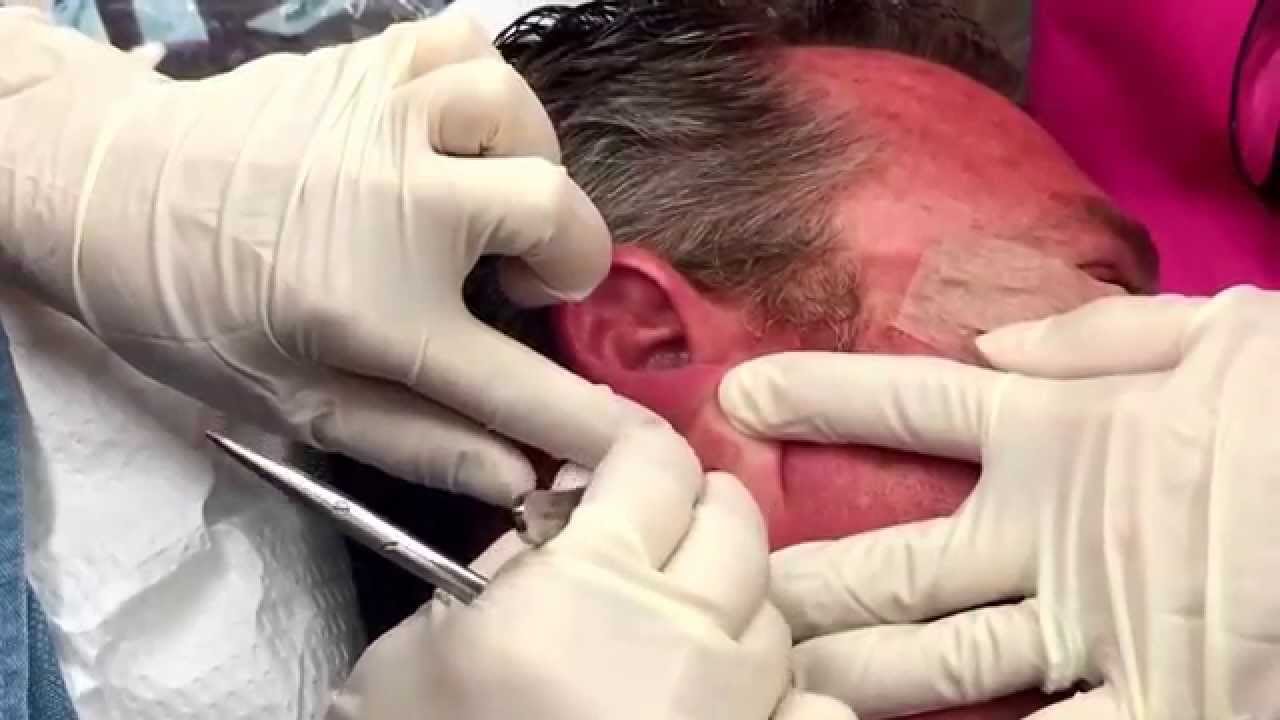 Punch Of An Epidermoid Cyst Behind The Ear For Medical Education Nsfe