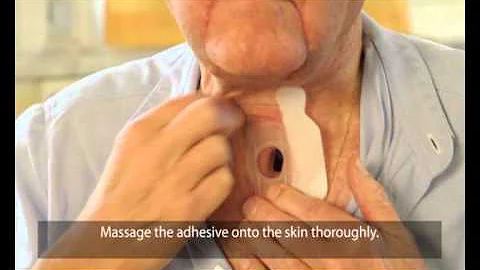 Attaching Provox StabiliBase adhesive