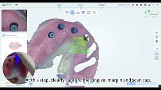 Workflow for Full Arch Edentulous Implant Scannin