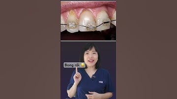 Bong mắc cài thì phải làm sao | Dr Anh Thư