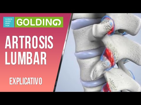 Artrosis Lumbar -